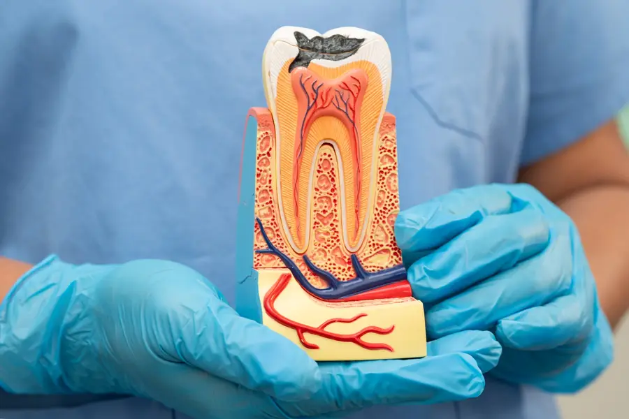 Modelo anatômico de um dente em corte, mostrando a cárie e os canais internos, segurado por um profissional de luvas.