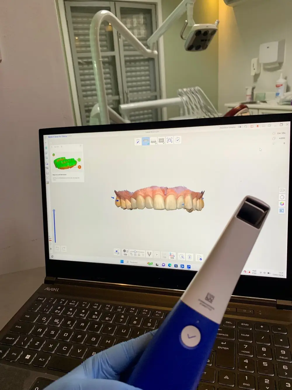 Scanner intraoral digital em uso, com o modelo 3D do sorriso exibido na tela do computador.
